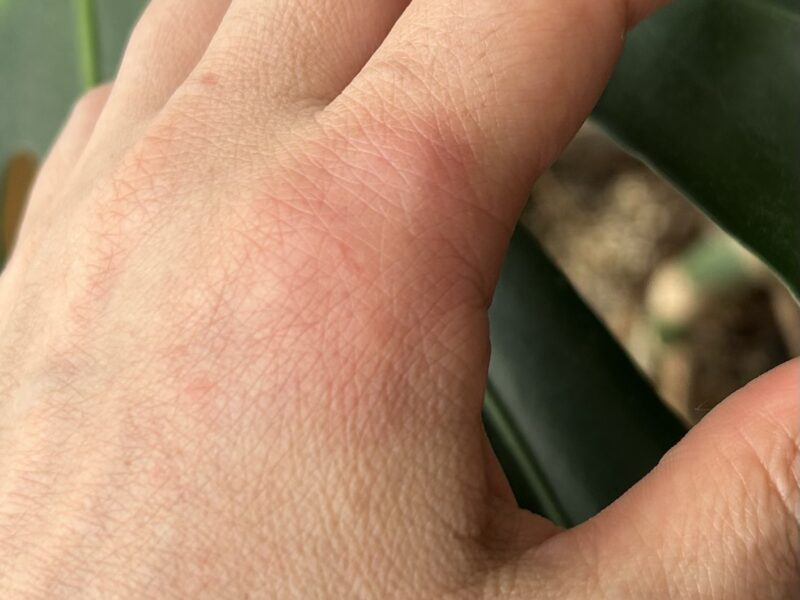 バラの棘が刺さって腫れた手
