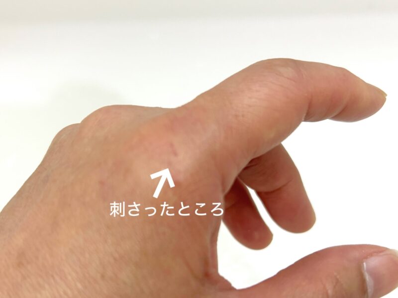 バラの棘が刺さって消毒してから2日後